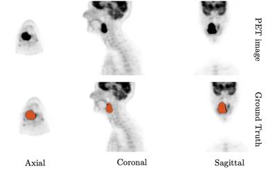 From coarse to fine: a deep 3D probability volume contours framework for tumour segmentation and dose painting in PET images